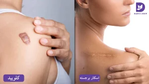 اسکار هایپرتروفیک و اسکار کلوئیدی